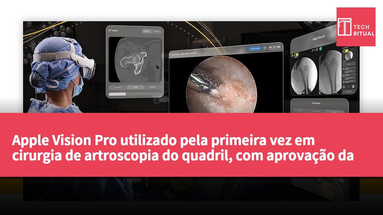 Apple Vision Pro utilizado pela primeira vez em cirurgia de artroscopia do quadril, com aprovação da FDA para a aplicação correspondente.